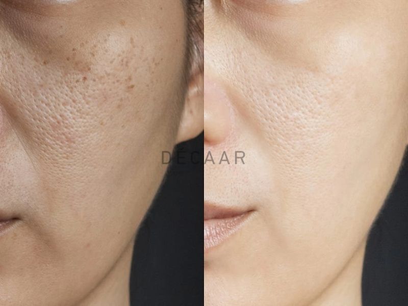 Ưu điểm peel da